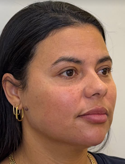 Depois: rosto da mesma paciente visto de perfil